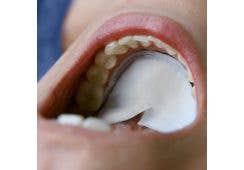 DryDent Sublingual: klein (small)